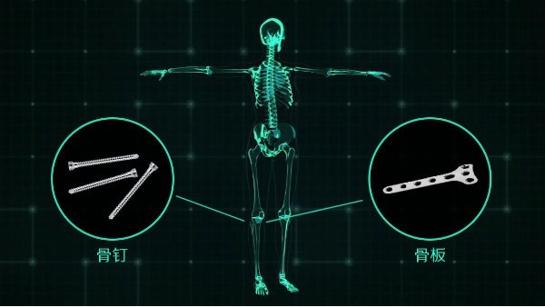 镁梦成真 《乐发500科技医用镁骨钉获欧盟CE认证》